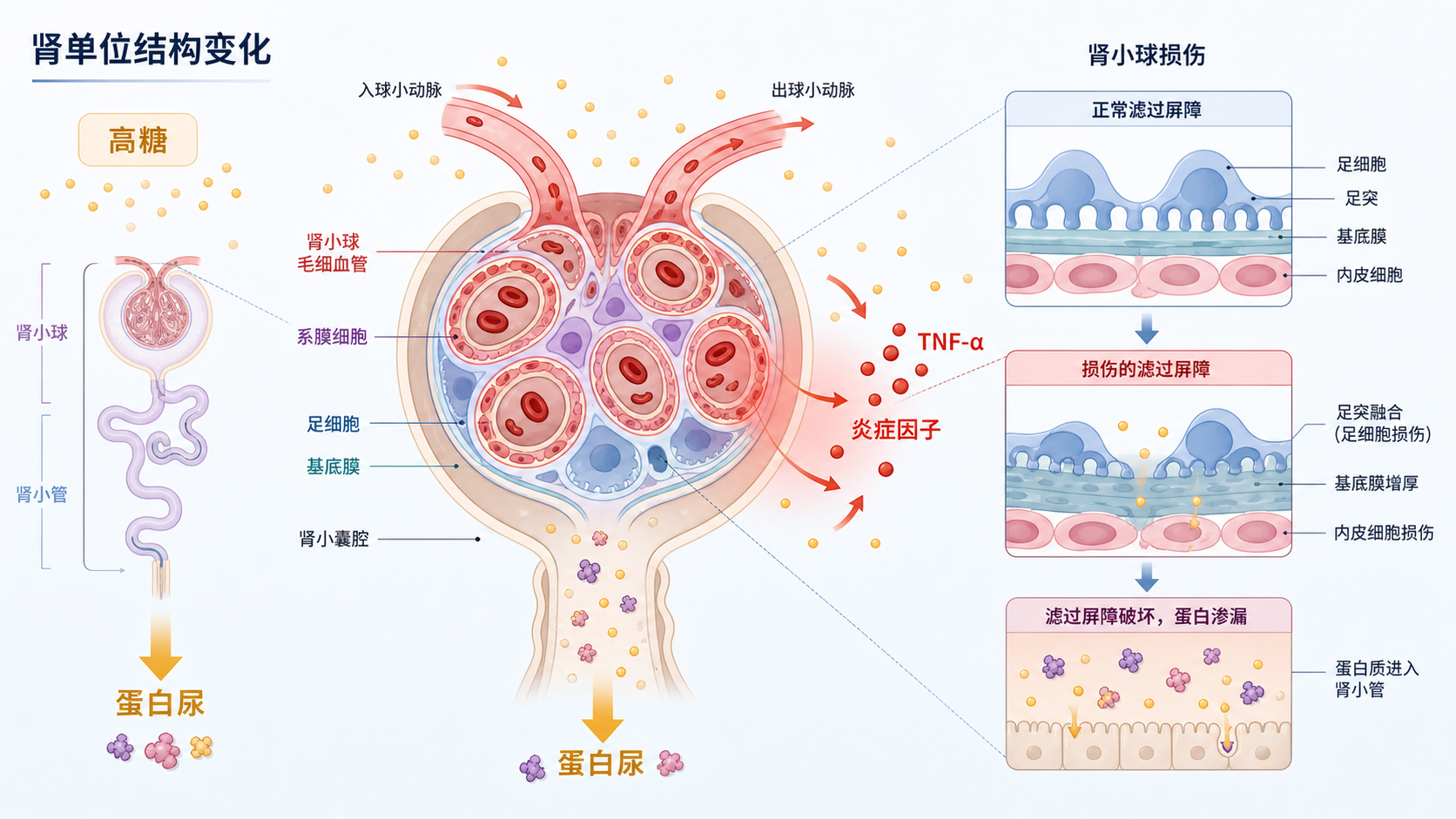 高糖环境下肾小球细胞受损示意图,突出TNF-α、炎症因子、蛋白尿和肾单位结构变化