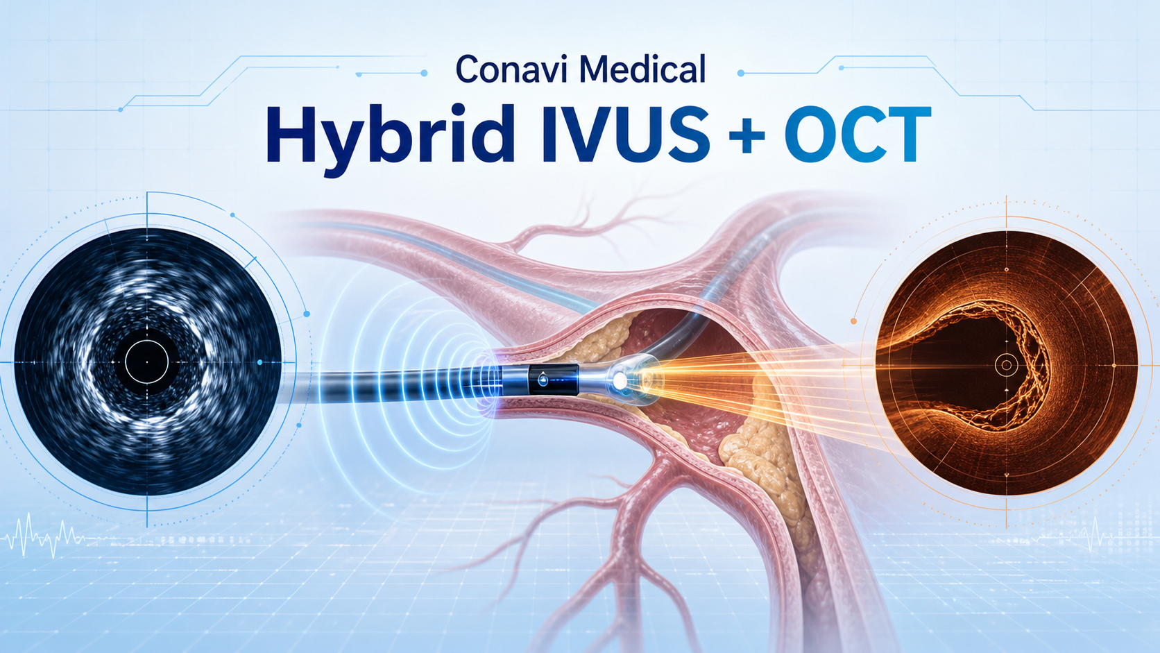 Conavi Medical 宣布将携其下一代混合血管内超声（IVUS）与光学相干断层成像（OCT）系统亮相 2026 年经导管心血管治疗大会（TCT 2026，10 月 31 日–11 月 3 日，美国圣迭戈）。该系统此前已获得美国 FDA 510(k) 批准，是首个将 IVUS 与 OCT 影像束共配准、共对准，从而在单一系统内实现冠脉混合成像的平台。此次是公司获批后首次在 TCT 亮相，并安排了专题报告、新临床前摘要与两场影像学教育讲座。